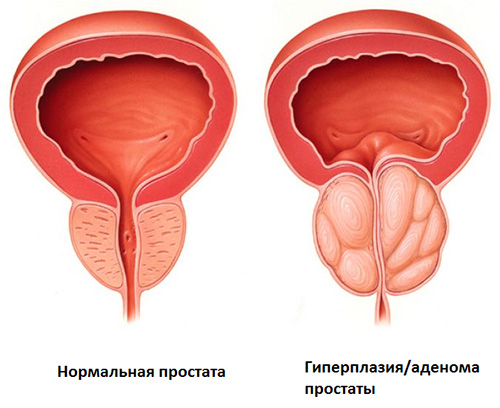 Аденома предстательной железы (Аденома простаты)