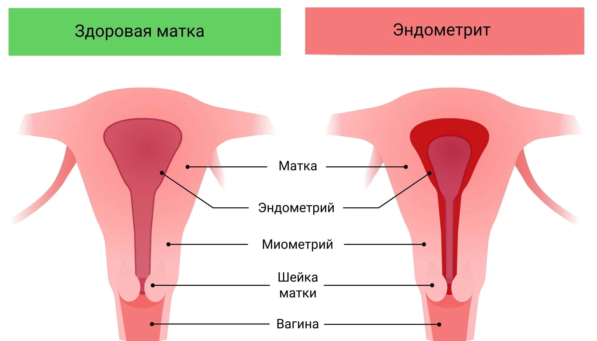 Хронический эндометрит: симптомы, причины, лечение у женщин