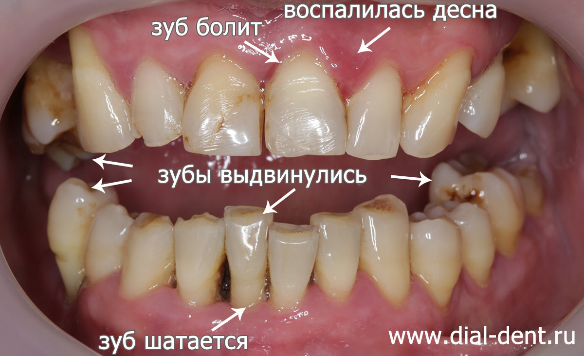 При пародонтозе шатаются зубы лечение