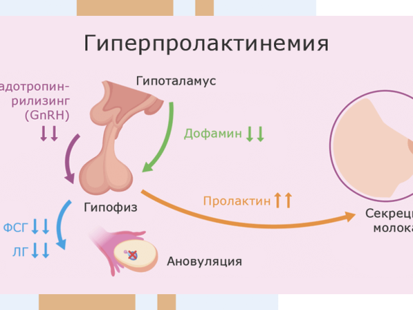 Пролактинома гипофиза симптомы у женщин лечение прогноз