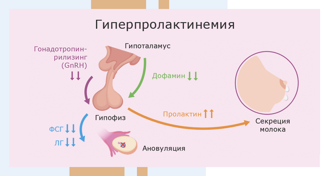 Пролактинома гипофиза симптомы у женщин лечение прогноз