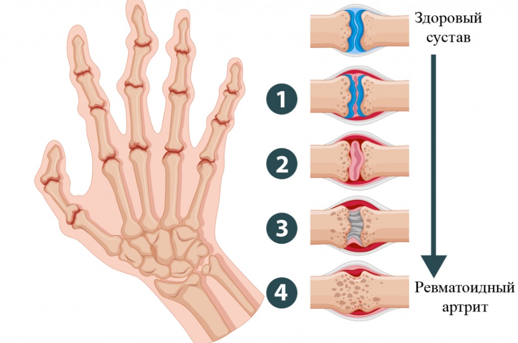 Ревматоидный артрит кистей рук