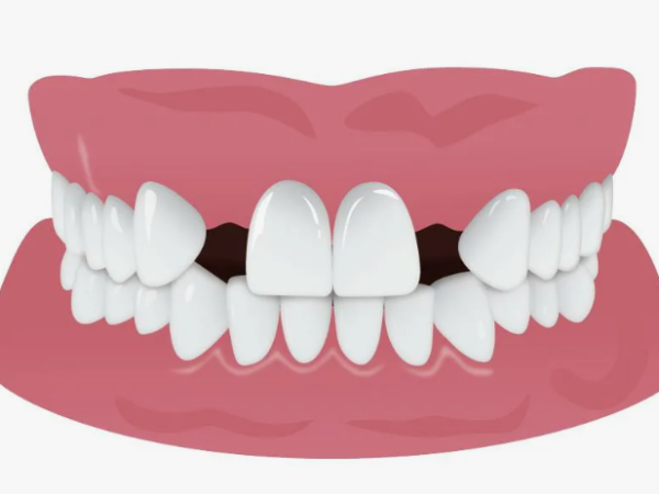 Частичная адентия: нужно ли начинать имплантацию зубов?
