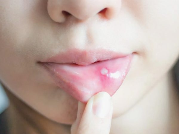 Лечение стоматита у детей по дням