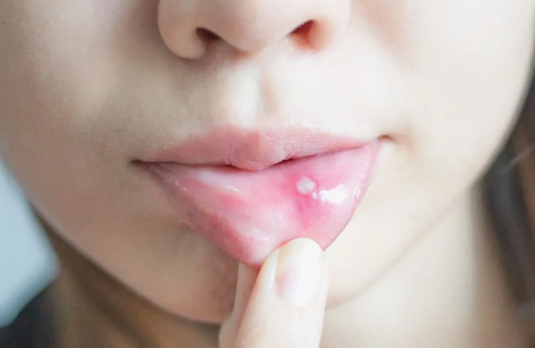 Лечение стоматита у детей по дням