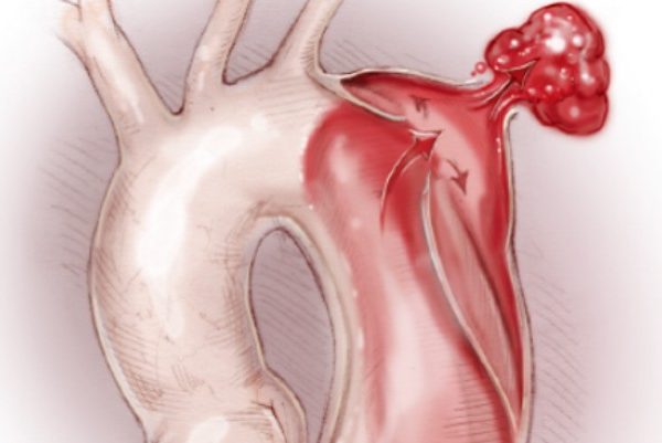 Профилактика разрыва аорты: как укрепить сердечно‑сосудистую систему