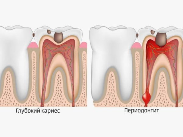 Лечение периодонтита у детей