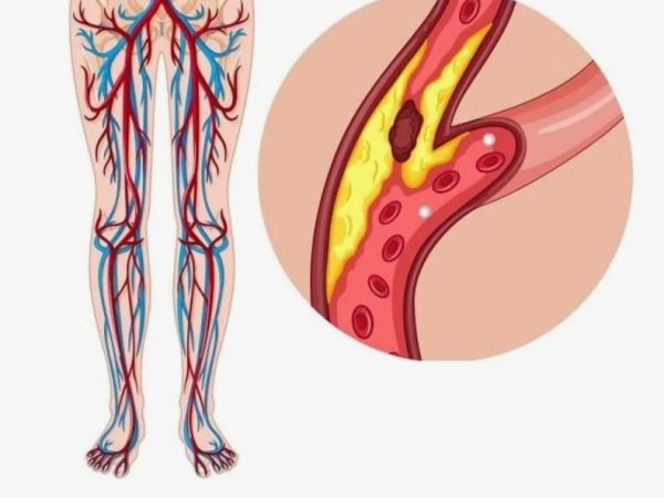 Атеросклероз, тромбоз, эмболия: три главные угрозы для сосудов, о которых нужно знать каждому
