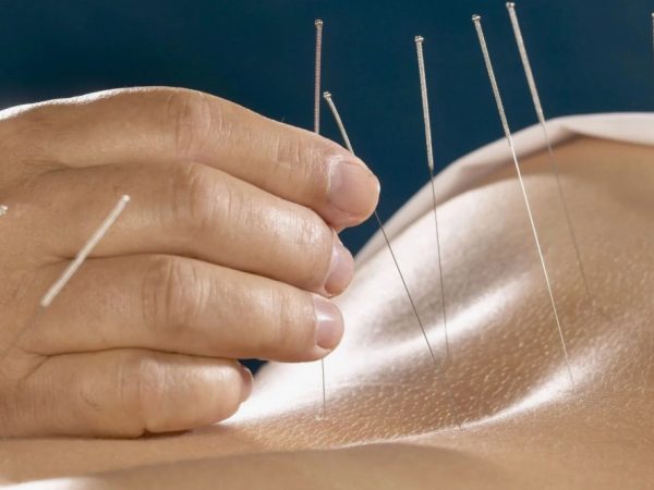 Рефлексотерапевт: когда иглы помогают лучше препаратов