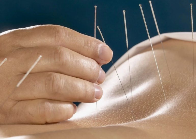 Рефлексотерапевт: когда иглы помогают лучше препаратов