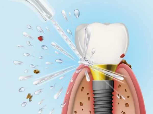 Ошибки при уходе за имплантами, которые могут стоить вам улыбки