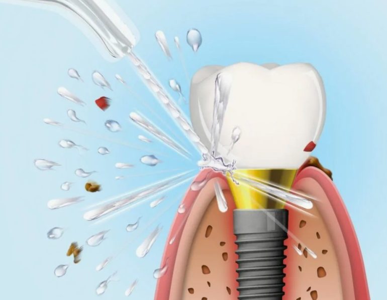 Ошибки при уходе за имплантами, которые могут стоить вам улыбки