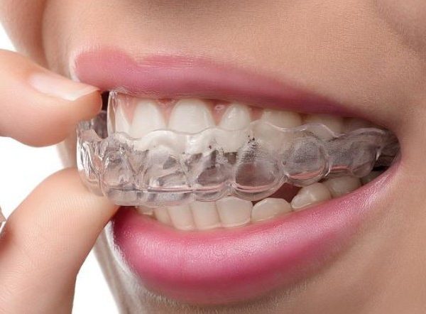 Элайнеры для зубов: почему прозрачные капы — это не только эстетика, но и здоровье суставов