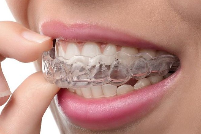 Элайнеры для зубов: почему прозрачные капы — это не только эстетика, но и здоровье суставов
