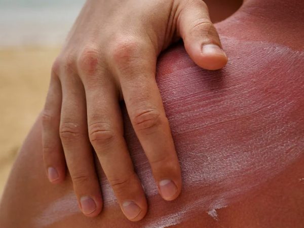 Как восстановить кожу после солнца и солярия