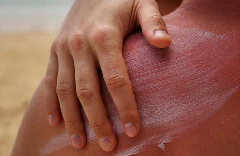 Как восстановить кожу после солнца и солярия