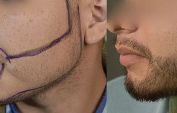 Пересадка бороды: когда эстетика становится частью самоуважения