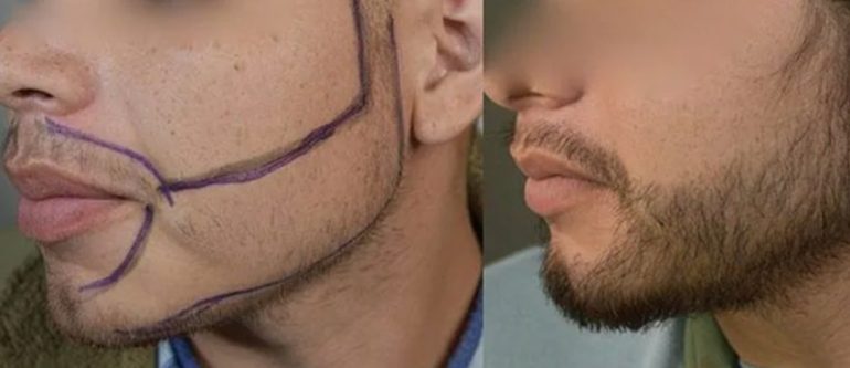 Пересадка бороды: когда эстетика становится частью самоуважения