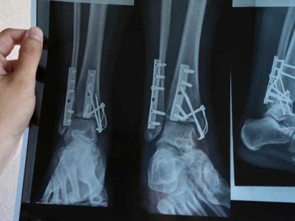 Рентген ноги: когда действительно нужно идти на обследование, а когда можно подождать
