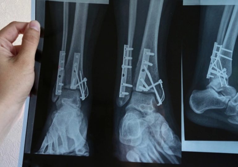 Рентген ноги: когда действительно нужно идти на обследование, а когда можно подождать