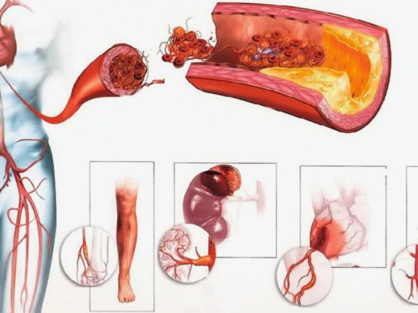 Болезни сосудов: какие симптомы нельзя игнорировать и когда бить тревогу