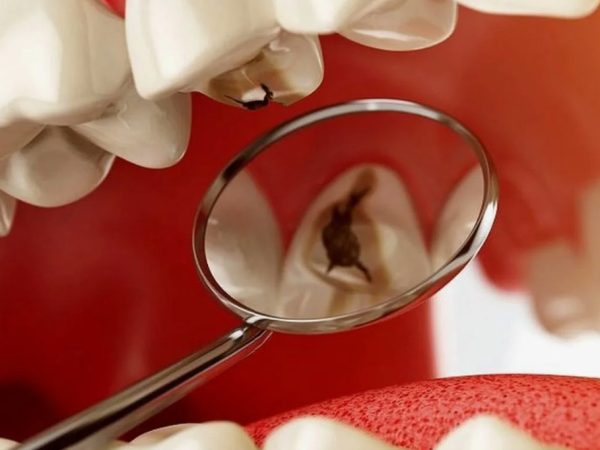 Стоматология и здоровье организма: почему нельзя игнорировать кариес