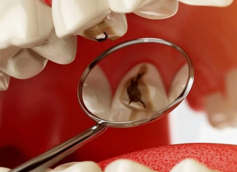 Стоматология и здоровье организма: почему нельзя игнорировать кариес