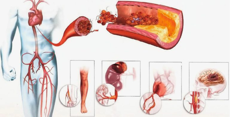 Болезни сосудов: какие симптомы нельзя игнорировать и когда бить тревогу