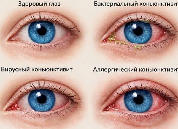Детские болезни глаз: пять тревожных сигналов, которые взрослые чаще всего игнорируют