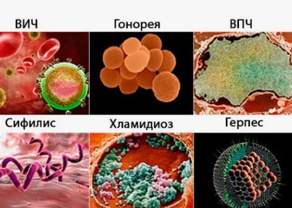 Скрытые угрозы: почему симптомы половых инфекций часто остаются незамеченными