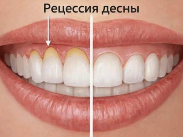 Опущение десны и подвижность зубов: способы остановить пародонтит и сохранить родную улыбку